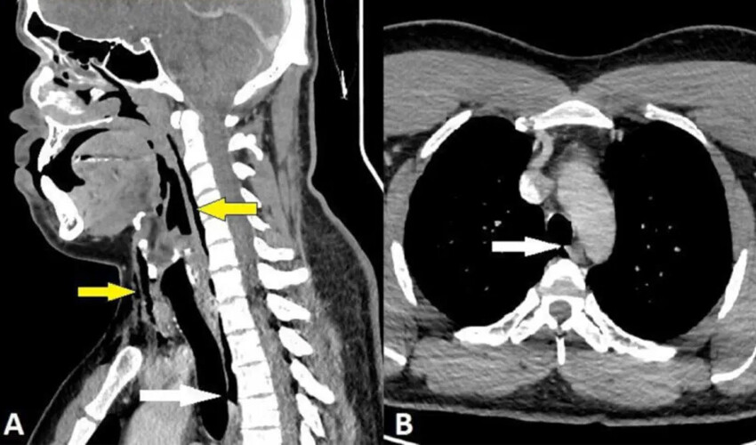 Hapşırığını tutan adamın boğazında delik açıldı