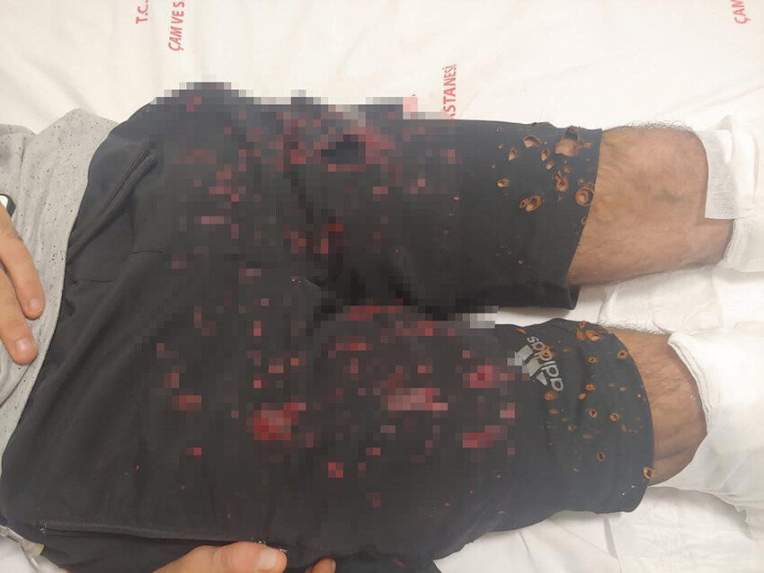 Herkesin evinde var! Bomba gibi patladı, vücudunun yüzde 35'i yandı Herkesin evinde var! Bomba gibi patladı, vücudunun yüzde 35'i yandı
