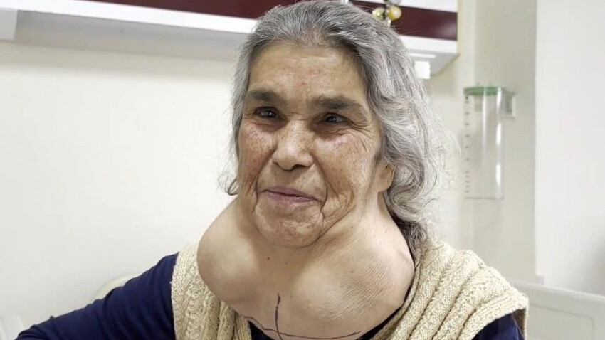 50 yıldır hastane kapısından geçmiyordu! Yüzü tanınmaz hale gelince doktora gitti… Meğer tek sebebi varmış 50 yıldır hastane kapısından geçmiyordu! Yüzü tanınmaz hale gelince doktora gitti… Meğer tek sebebi varmış