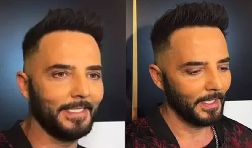 Son görüntüsü şaşırtan Gökhan Özen veryansın etti, estetik iddialarına filtresiz videoyla cevap verdi