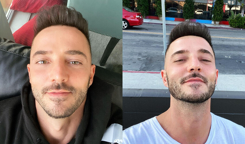 Son görüntüsü şaşırtan Gökhan Özen veryansın etti, estetik iddialarına filtresiz videoyla cevap verdi