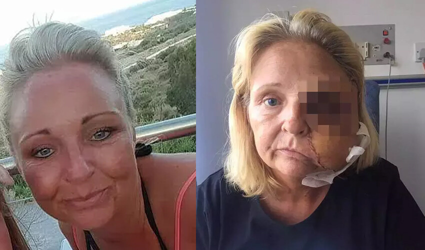 Et yiyen bakteri vakaları pik yaptı Et yiyen bakteri vakaları pik yaptı