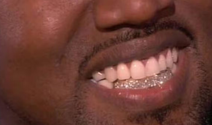 Ağzında artık servet yatıyor… Tüm dişlerini söktüren Kanye West titanyum protez taktırdı