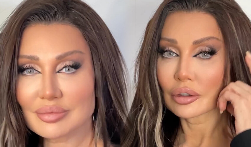 Alın daraltma ameliyatı olan Umut Akyürek son halini paylaştı! Dikkat çeken detay… Alın daraltma ameliyatı olan Umut Akyürek son halini paylaştı! Dikkat çeken detay…