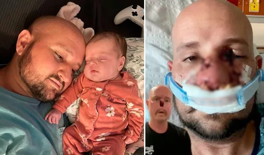 Grip belirtileriyle başladı, burnunu kaybetti! Hastalığı milyonda iki görülüyor…