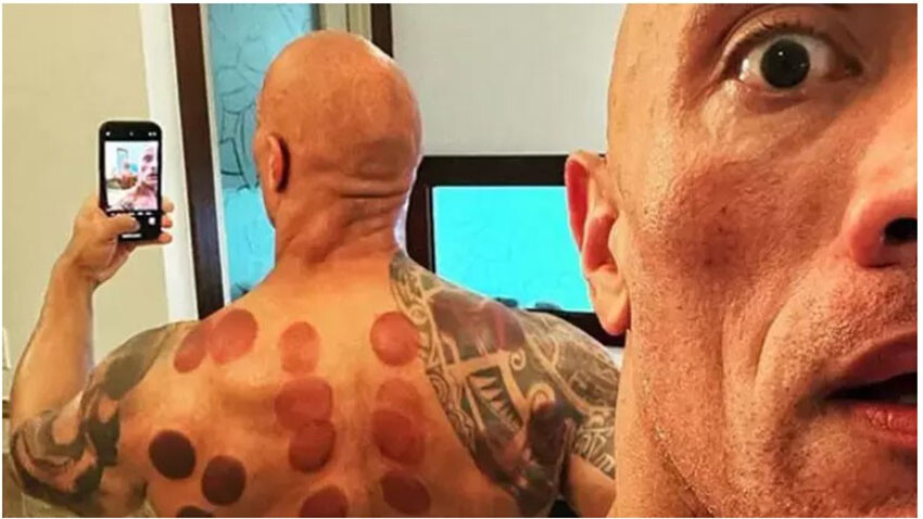 Dünya yıldızları da keşfetti, hacamat vücudun devası