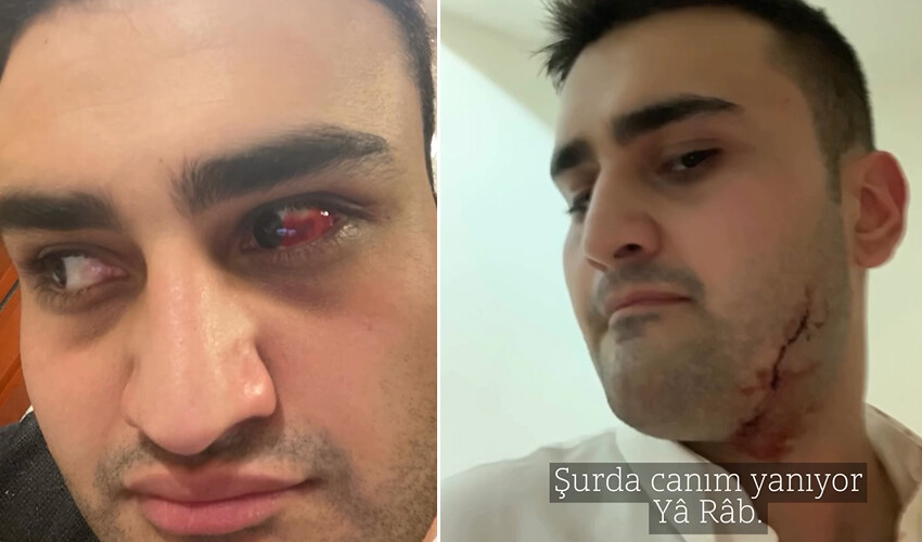 CZN Burak’ın vücudu kesikler içindeki hali korkutmuştu! Fotoğrafların iç yüzünü açıkladı