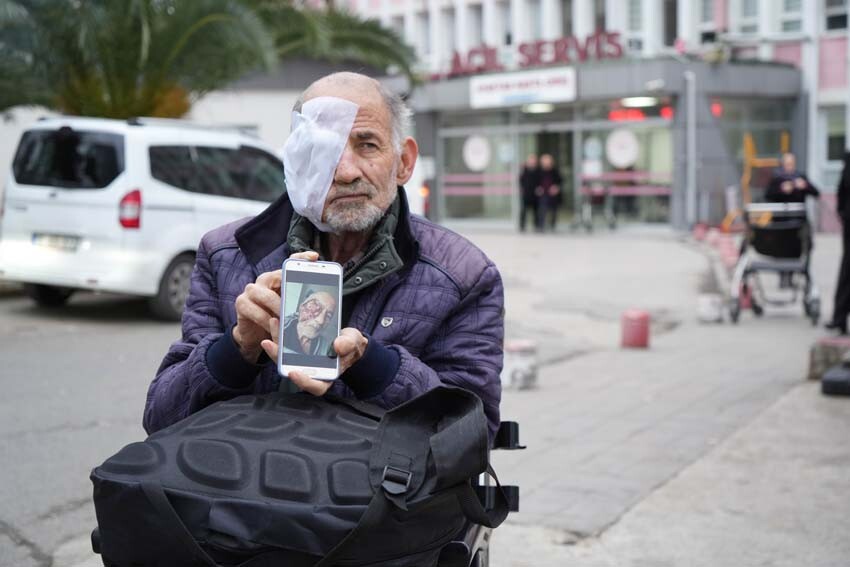 Nadir görülen hastalık hayatını alt üst etti: Gözü akıyor, suratı mum gibi eriyor...