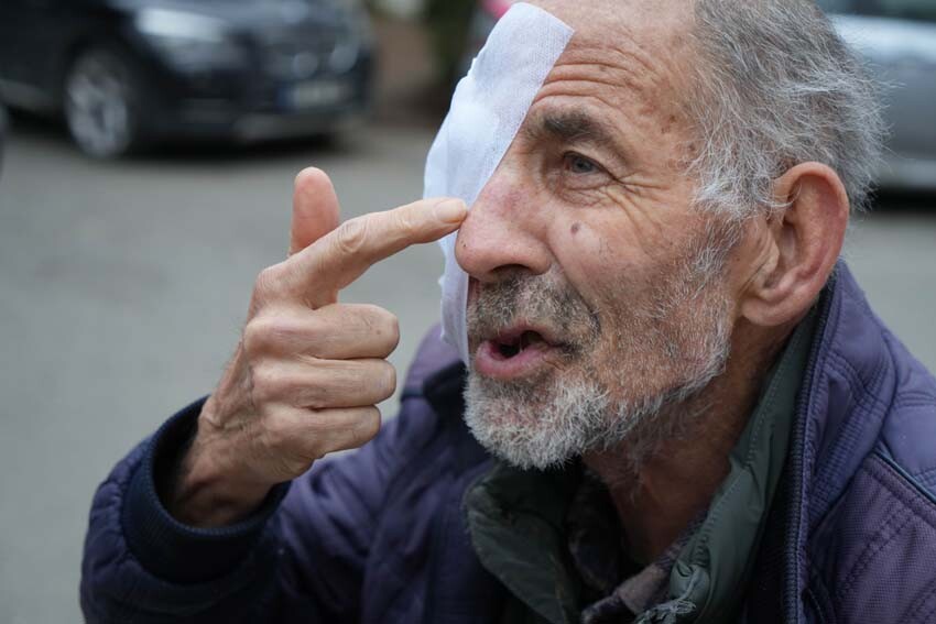 Nadir görülen hastalık hayatını alt üst etti: Gözü akıyor, suratı mum gibi eriyor...