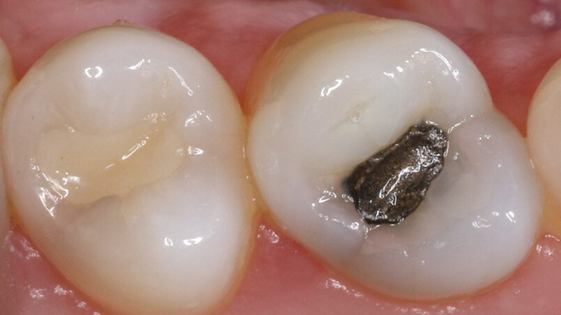 Ağızdaki ‘sinsi’ tehlike! Avrupa Birliği yasaklıyor... Dişinde amalgam dolgusu olanlar dikkat Ağızdaki ‘sinsi’ tehlike! Avrupa Birliği yasaklıyor... Dişinde amalgam dolgusu olanlar dikkat