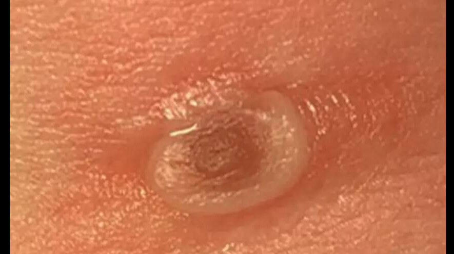 Yeni kabus Alaskapox! Alaska'da ilk ölüm gerçekleşti, hayvanlardan insanlara bulaşıyor Yeni kabus Alaskapox! Alaska'da ilk ölüm gerçekleşti, hayvanlardan insanlara bulaşıyor