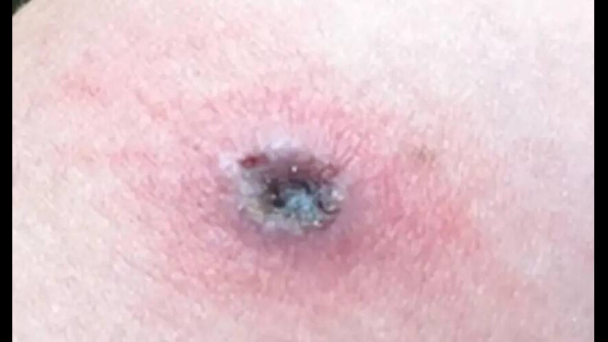 Yeni kabus Alaskapox! Alaska'da ilk ölüm gerçekleşti, hayvanlardan insanlara bulaşıyor Yeni kabus Alaskapox! Alaska'da ilk ölüm gerçekleşti, hayvanlardan insanlara bulaşıyor