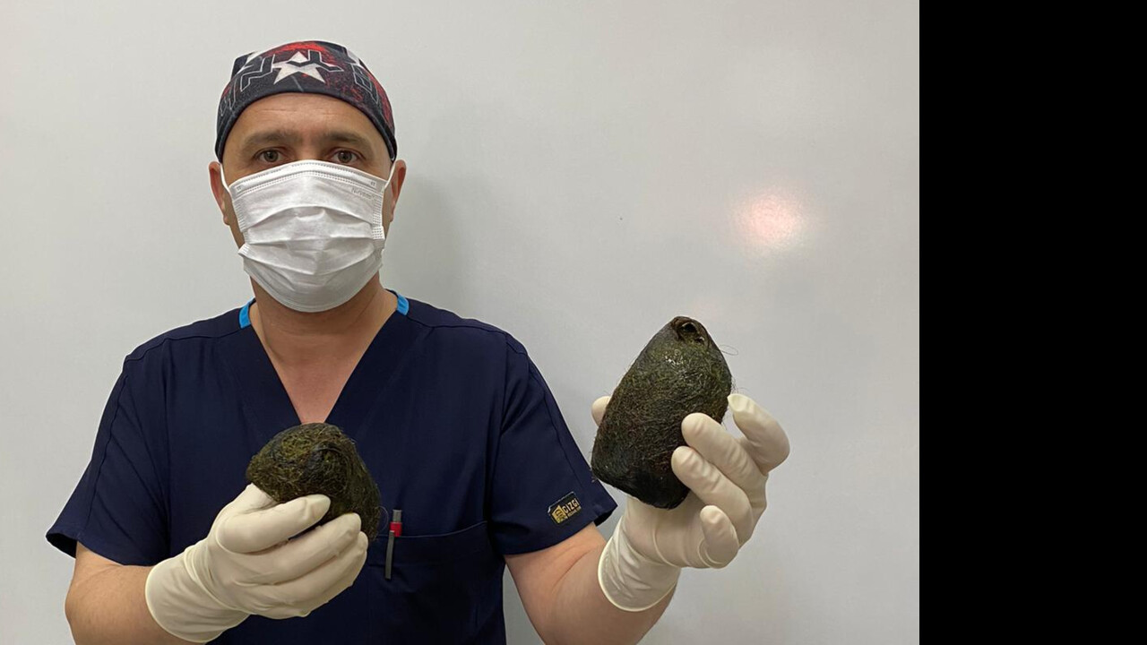 Karın ağrısı şikayetiyle hastaneye başvuran kadının midesinden 2 kilo saç çıktı