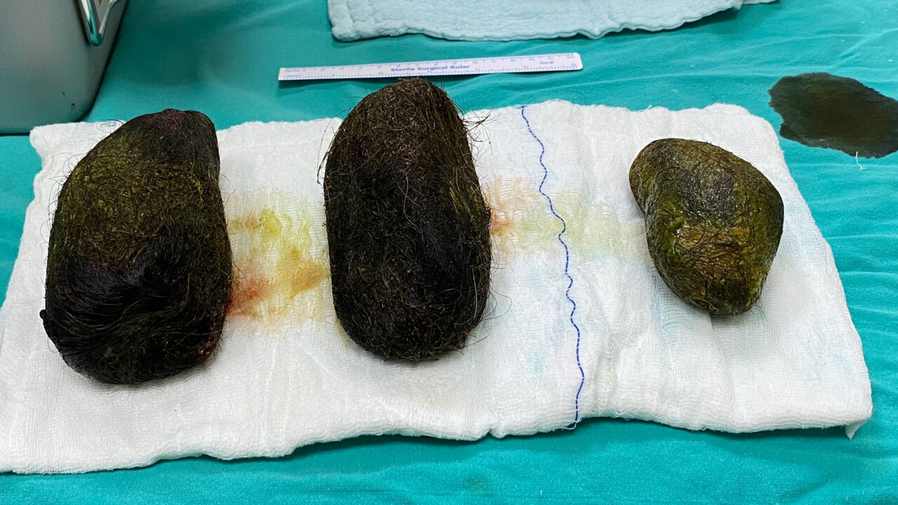 Karın ağrısı şikayetiyle hastaneye başvuran kadının midesinden 2 kilo saç çıktı