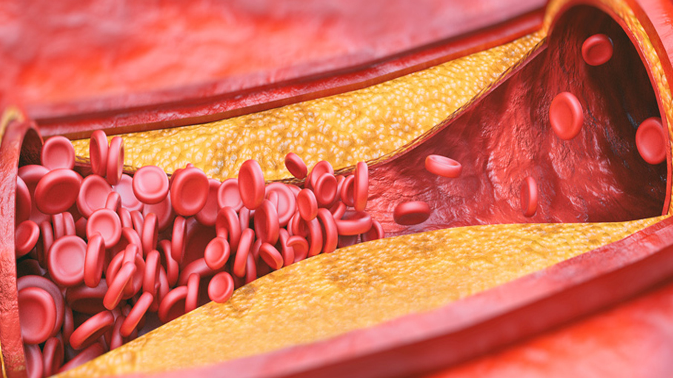 Vitrin hastalığını hafife almayın! Yürüyünce ortaya çıkıyor, uzuv kaybına neden oluyor Vitrin hastalığını hafife almayın! Yürüyünce ortaya çıkıyor, uzuv kaybına neden oluyor