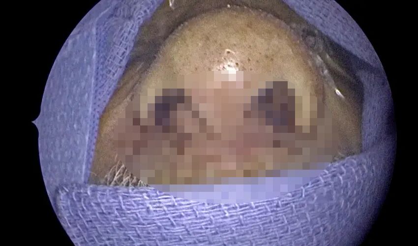 Tıp literatüründe böylesi görülmedi! Burnundan 150 canlı kurtçuk çıktı, hepsi de canlı - 1. Resim