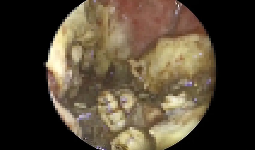 Tıp literatüründe böylesi görülmedi! Burnundan 150 canlı kurtçuk çıktı, hepsi de canlı - 2. Resim