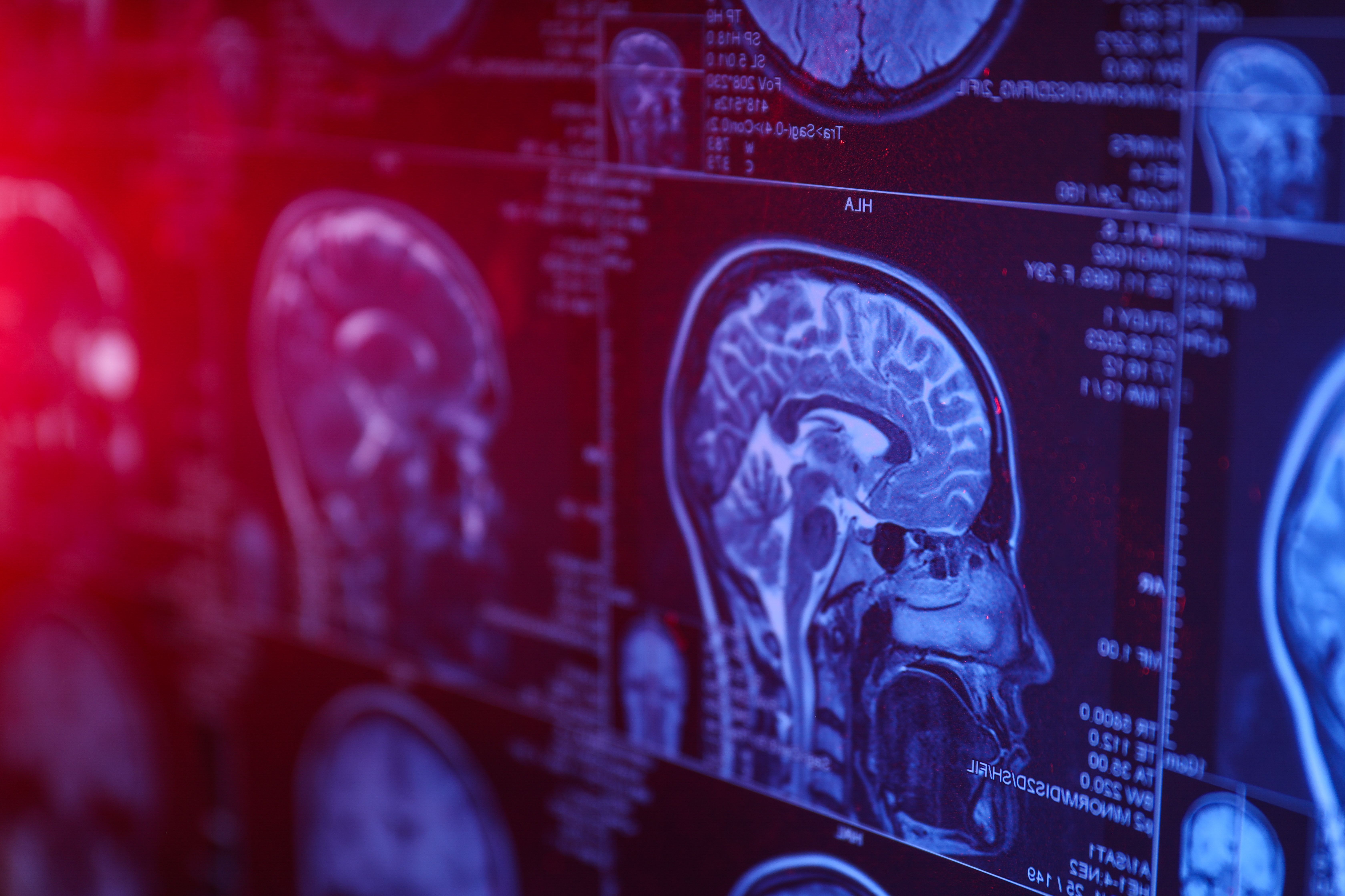Alzheimer teşhisinde ‘yapay zeka’ devrimi: Tükürük örneğiyle ortaya çıkacak Alzheimer teşhisinde ‘yapay zeka’ devrimi: Tükürük örneğiyle ortaya çıkacak - 1. Resim