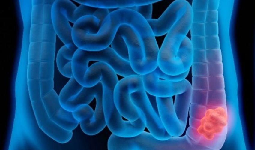 Gençlere de sıçradı! İşlenmiş gıdalar sebep oluyor Gençlere de sıçradı! İşlenmiş gıda sebep oluyor - 1. Resim