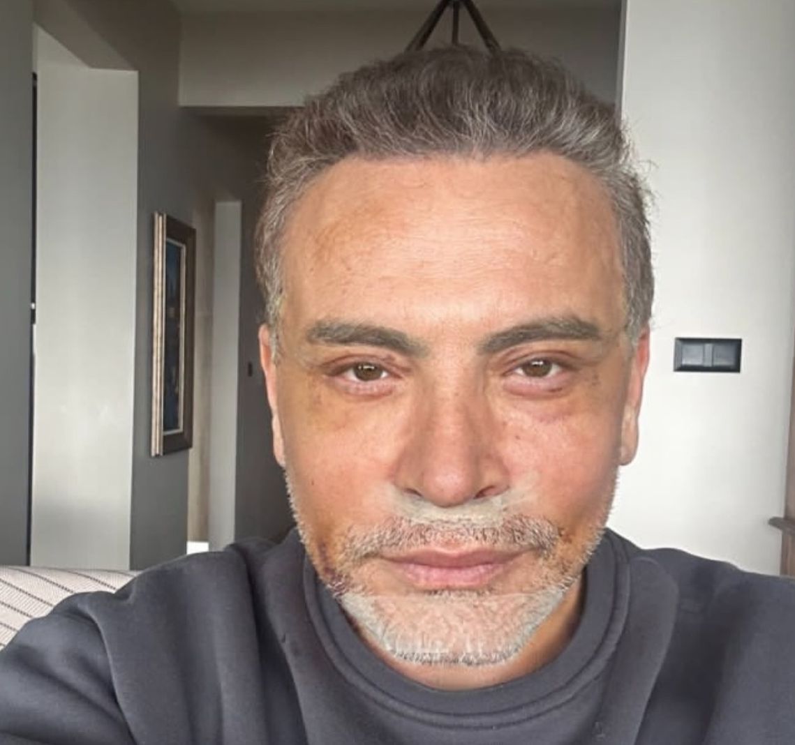 Değişimiyle ağızları açık bırakan Cenk Eren'in estetik için ödediği ücret ortaya çıktı - 2. Resim