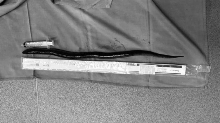 Karın ağrısı şikayetiyle hastaneye gitti, karnından 30 cm'lik canlı yılan balığı çıktı  - 1. Resim