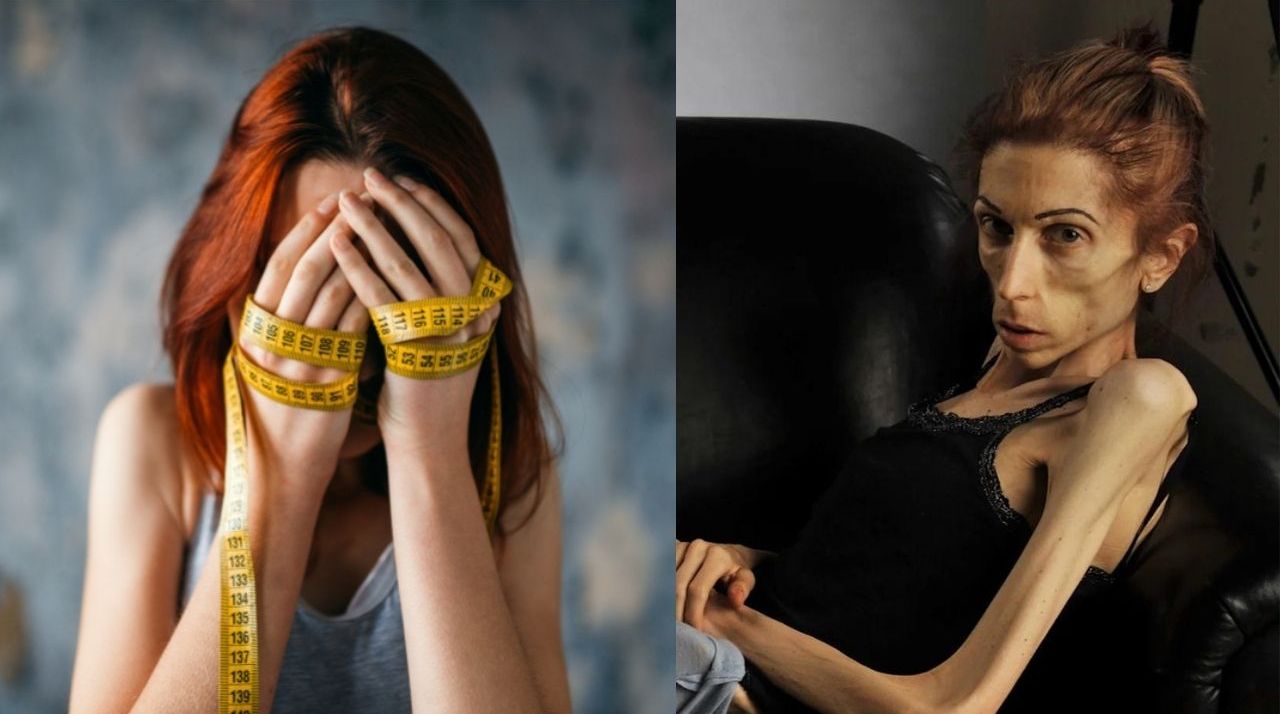 Nihal Candan'ın yakalandığı Anoreksiya Hastalığı belirtileri ve tedavisi - 2. Resim