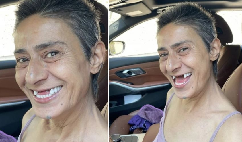 İmplant tedavisine başlayan Yıldız Tilbe dişsiz kaldı! Son hali çok konuşuldu İmplant tedavisine başlayan Yıldız Tilbe dişsiz kaldı! Son hali çok konuşuldu - 1. Resim