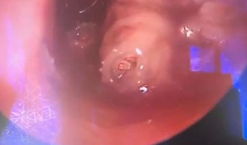 Ağrı şikayetiyle gitti, kulağından canlı kurtçuk çıkarıldı - 1. Resim