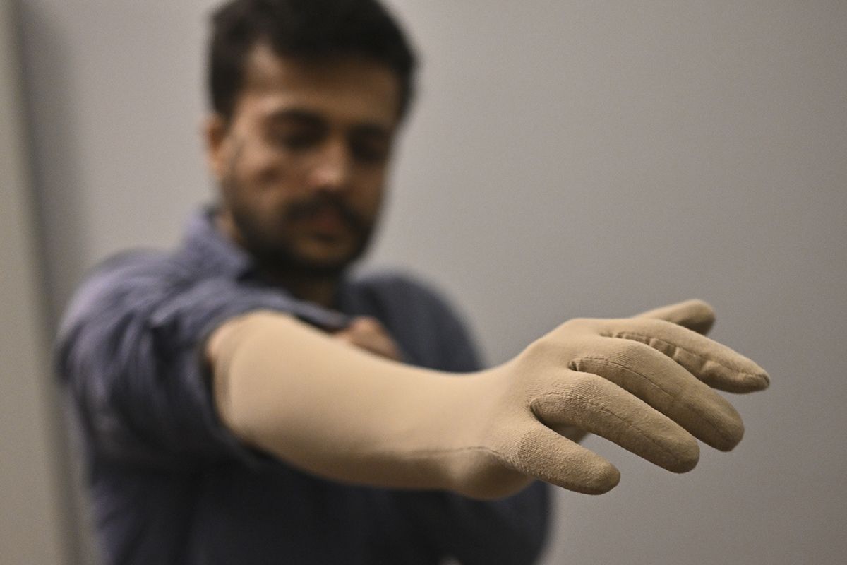 Genetik XP hastası olan kardeşler gün ışığına hasret - 2. Resim