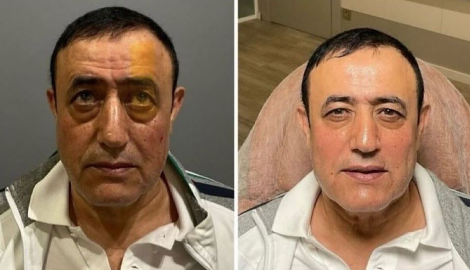 Estetik yaptıran Mahmut Tuncer’in değişimi şaşırttı! 62 yaşındaki türkücünün son hali… Estetik yaptıran Mahmut Tuncer’in değişimi şaşırttı! 62 yaşındaki türkücünün son hali… - 1. Resim