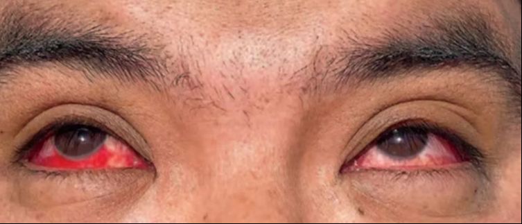 Mandırada çiftçilik yapan adama inekten kuş gribi bulaştı! Gözleri kan çanağına döndü Mandırada çiftçilik yapan adama inekten kuş gribi bulaştı! Gözleri kan çanağına döndü - 1. Resim