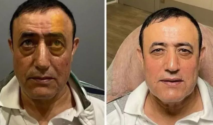 Yüzündeki değişimle gündem olan Mahmut Tuncer sessizliğini bozdu: Eşim beni tezgaha düşürdü - 1. Resim