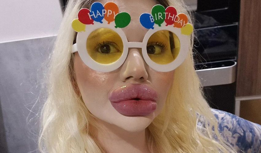 Dünyanın en büyük dudaklı kadını yeni hedefi için hareketi geçti! İsteğiyle doktoruna bile ‘pes’ dedirtti - 2. Resim