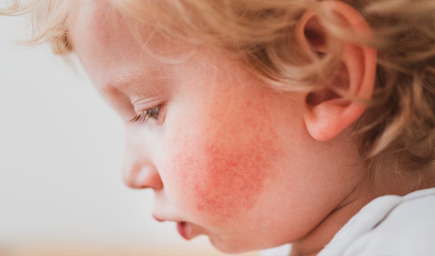 Çocuğun yanağında tokat izine benzer bir kızarıklık varsa dikkat! Vakalar arttı, uzmanlar uyardı - 2. Resim