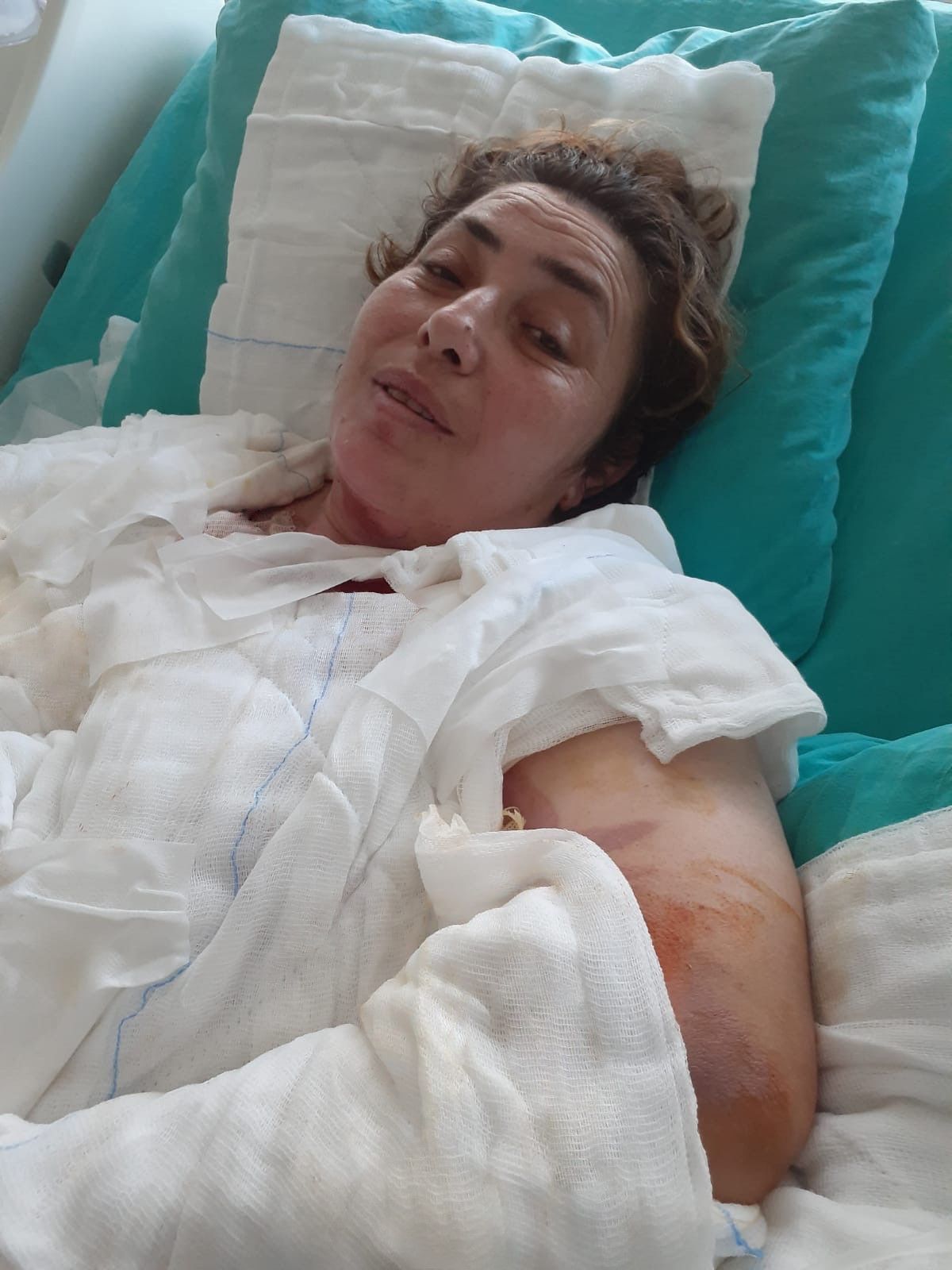 Düdüklü tencere hayatını kabusa çevirdi: 5 ameliyat geçirdi, tedavisi günlerce sürdü... Düdüklü tencere hayatını kabusa çevirdi: 5 ameliyat geçirdi, tedavisi günlerce sürdü... - 4. Resim