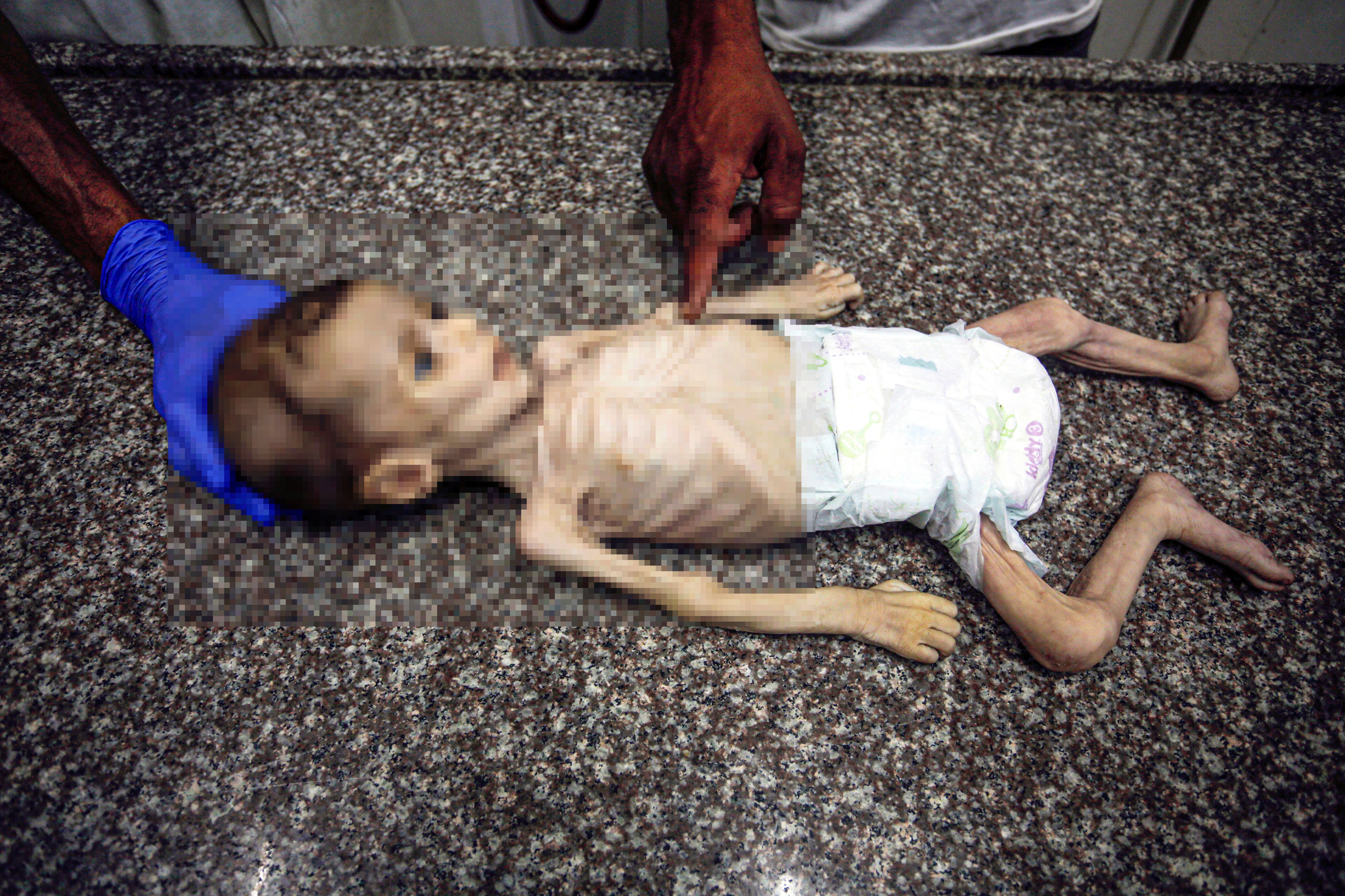 İsrail, Filistinlileri açlığa mahkum etti! 7 aylık bebeğin görüntüsü tüyleri diken diken etti İsrail, Filistinlileri açlığa mahkum etti! 7 aylık bebeğin görüntüsü tüyleri diken diken etti - 2. Resim