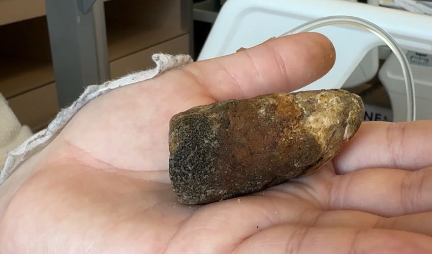 Ağrı içinde acile gitti, felaketi yaşadı! ‘Böyle bir taş görülmemiş’ - 2. Resim