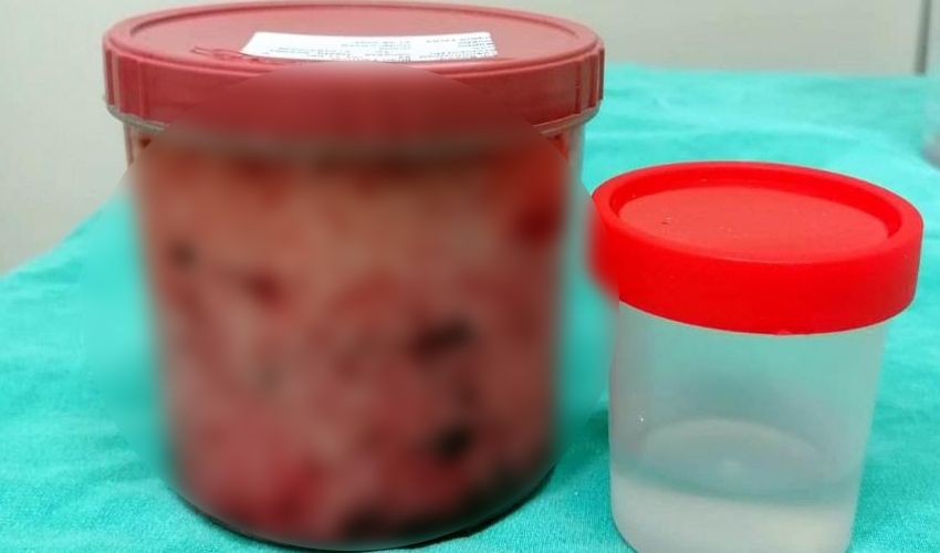 Ameliyattan yıllarca kaçtı, sonunda doktora gitti! 350 gram prostat çıkarıldı - 2. Resim