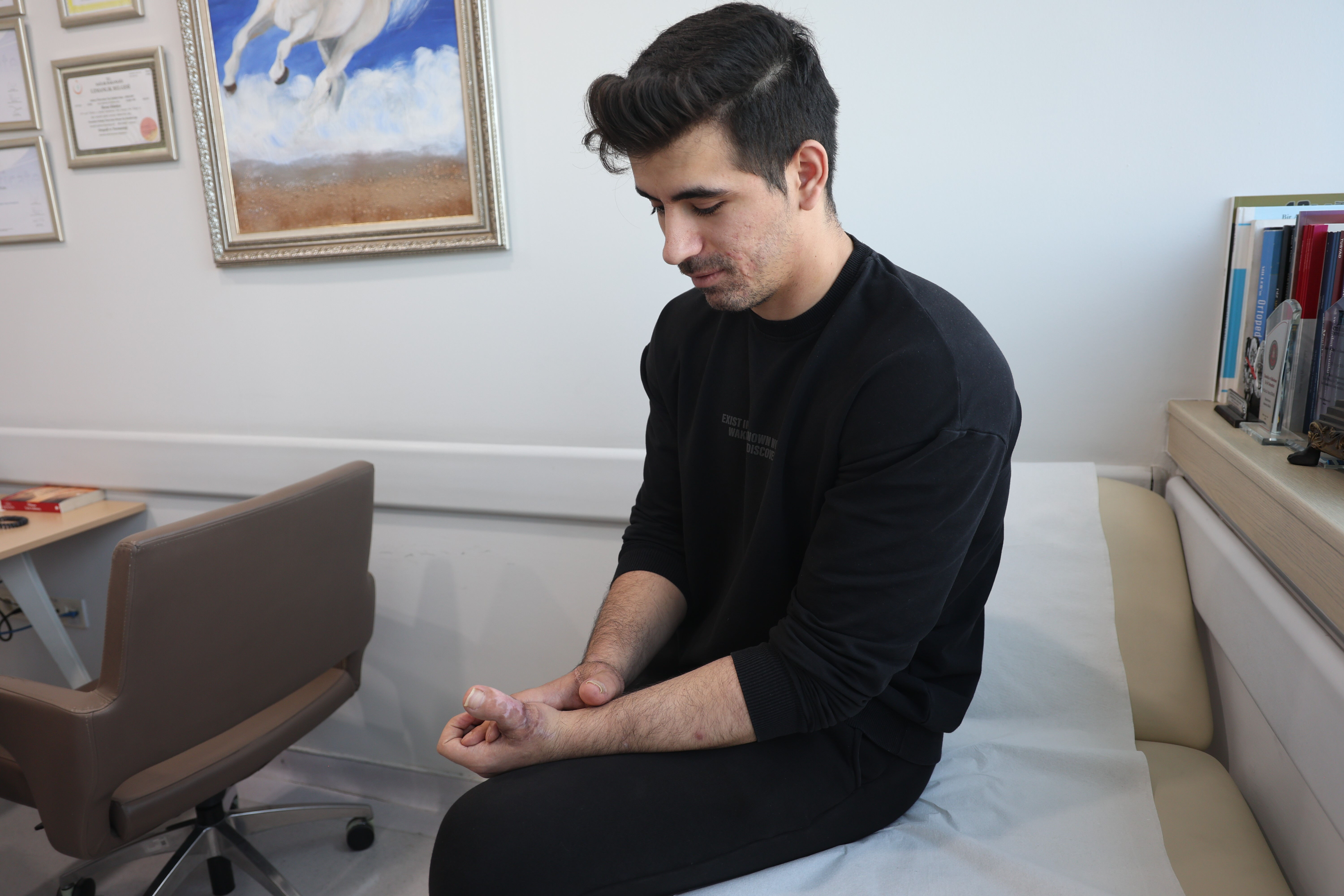 350 tonluk pres parmaklarını koparmıştı: Ayak parmakları eline dikildi 350 tonluk pres parmaklarını koparmıştı: Ayak parmakları eline dikildi - 2. Resim