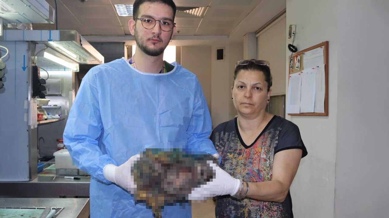 Karın ağrısı şikayetiyle hastaneye gitti, karnından çıkana doktorlar bile inanamadı Karın ağrısı şikayetiyle hastaneye gitti, karnından çıkana doktorlar bile inanamadı - 2. Resim