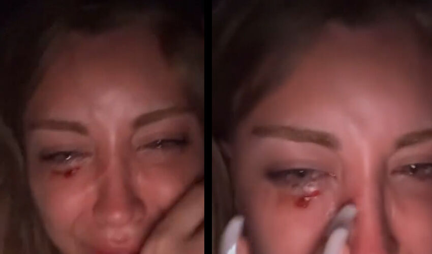 Fenomen Mika Raun sokak ortasında saldırıya uğradı! ‘Öldüresiye dövüldüm’ Fenomen Mika Raun sokak ortasında saldırıya uğradı! ‘Öldüresiye dövüldüm’ - 2. Resim