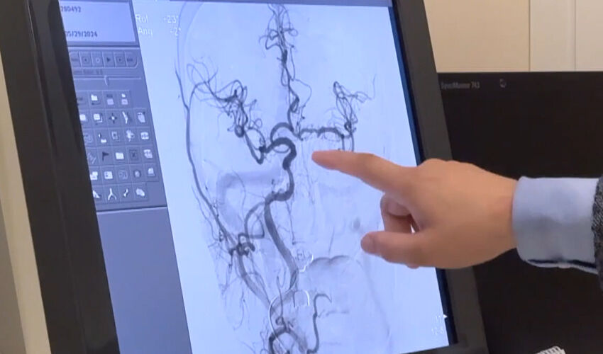 Kalıcı inme ve felci önlüyor! Yüzlerce hastaya ‘şah damarı tıkanıklığı’ müdahalesi - 1. Resim