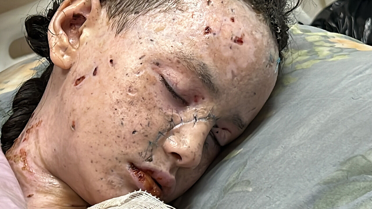 Gazze'de son durum... Yürek yakan kare... 9 yaşındaki Hanan Alaa Akl yaşam mücadelesi veriyor! - 3. Resim