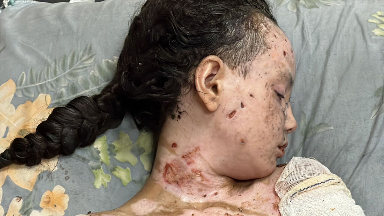 Gazze'de son durum... Yürek yakan kare... 9 yaşındaki Hanan Alaa Akl yaşam mücadelesi veriyor! - 2. Resim