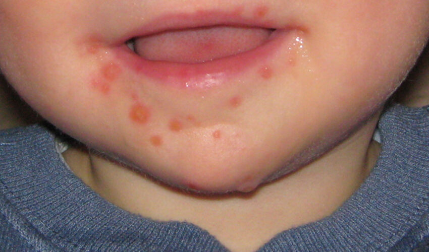 Anne babalar dikkat: Salgın var! El, ayak, ağız hastalığı en çok havuzdan bulaşıyor - 1. Resim