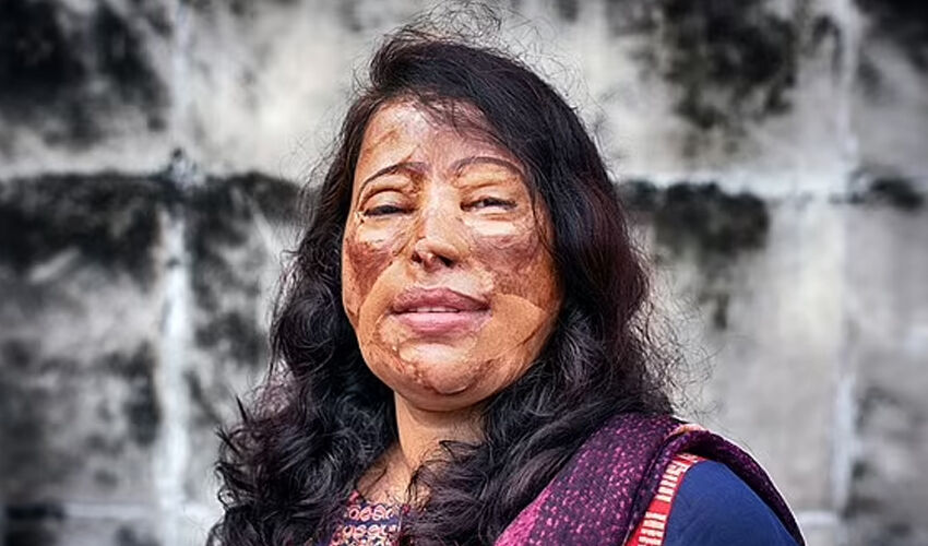 Asitli saldırıya uğrayan kadın 15 yaşındayken kabusu yaşadı! Yıllar sonra yaptığıyla takdir topluyor - 2. Resim