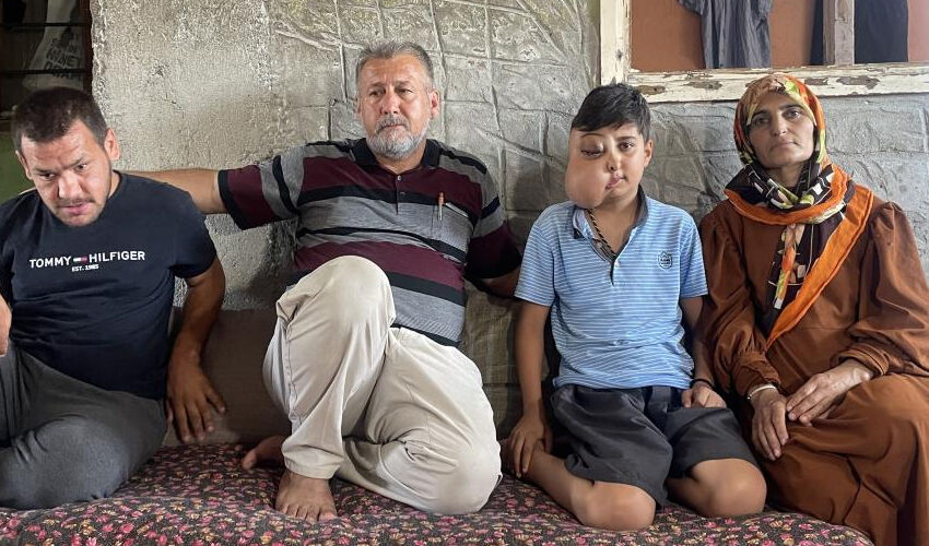 Milyonda bir görülen hastalık: İki farklı yüzü var gibi görünüyor, ailesi doktor doktor gezip çare arıyor Milyonda bir görülen hastalık: İki farklı yüzü var gibi görünüyor, ailesi doktor doktor gezip çare arıyor - 3. Resim