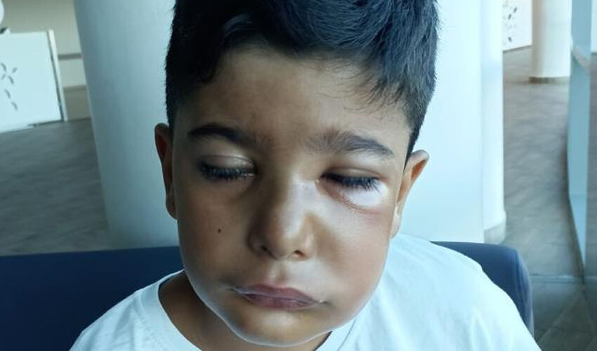Yanlış tedavi kabusu yaşattı! 8 yaşındaki çocuk az kalsın gözünü kaybediyordu - 1. Resim