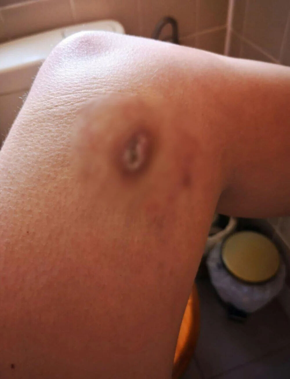 O gece hayatının kabusunu yaşadı... Sabah yanıklarla uyandı! Sonrası korkun&ccedil;... - 1. Resim