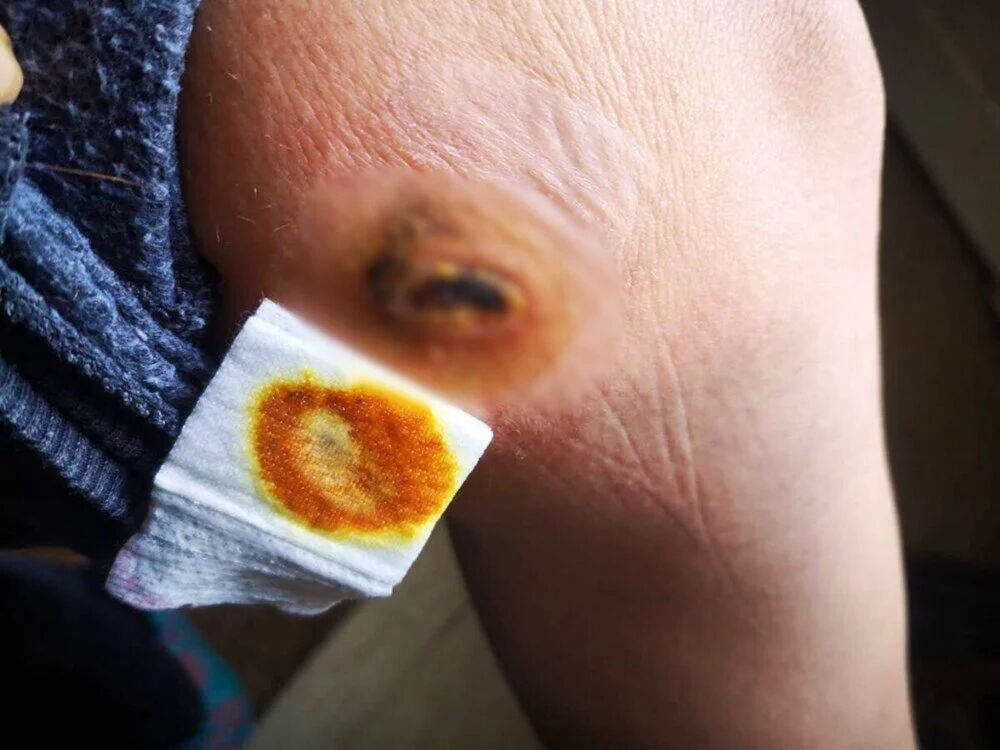 O gece hayatının kabusunu yaşadı... Sabah yanıklarla uyandı! Sonrası korkun&ccedil;... - 2. Resim